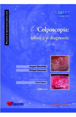 Colposcopia: tehnica si diagnostic - Jacques Marchetta, Philippe Descamps, Corina Grigoriu 1 Colposcopia: tehnica si diagnostic - Jacques Marchetta, Philippe Descamps, Corina Grigoriu